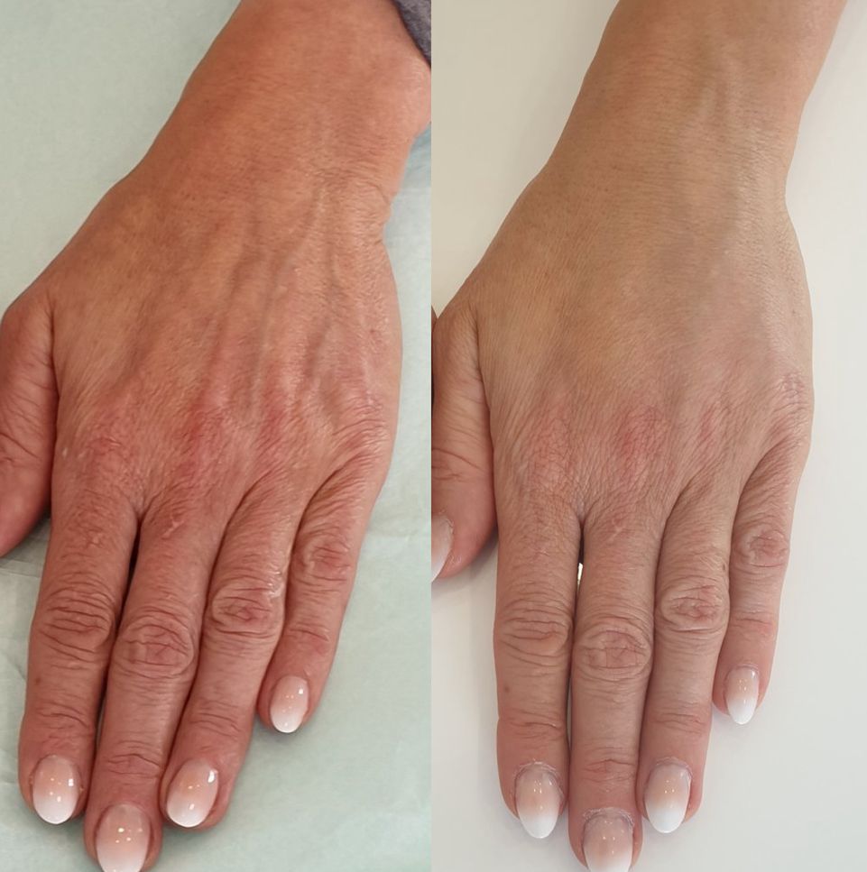 Bioestimulador para Mãos — NanoLift Hands